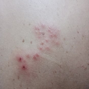 Apranax Ford İlacı Kullanımından Sonra Süregelen Kaşıntı Ve Ağrı Şikayetleri