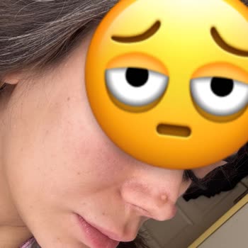 İzin Almadan Tekrarlanan Burun Ameliyatı Ve Sağlık İhmali