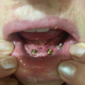 Dent Akademi 82.585 TL’lik İmplant Tedavisinde Sürekli Kırılan Protez Ve İhmal