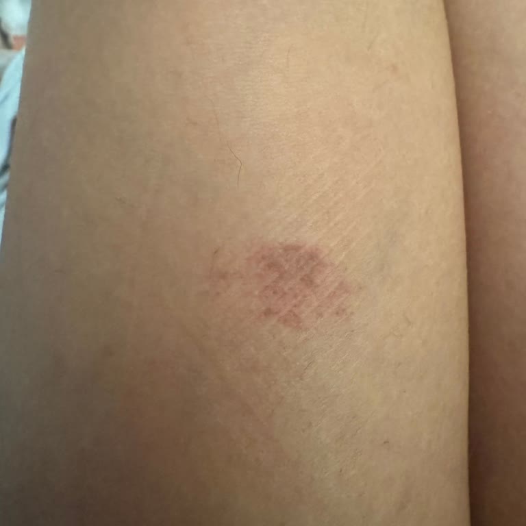 Lazer Epilasyon Sonrası Yanık Ve İz İçin Tedavi Masraflarının Karşılanması Talebi