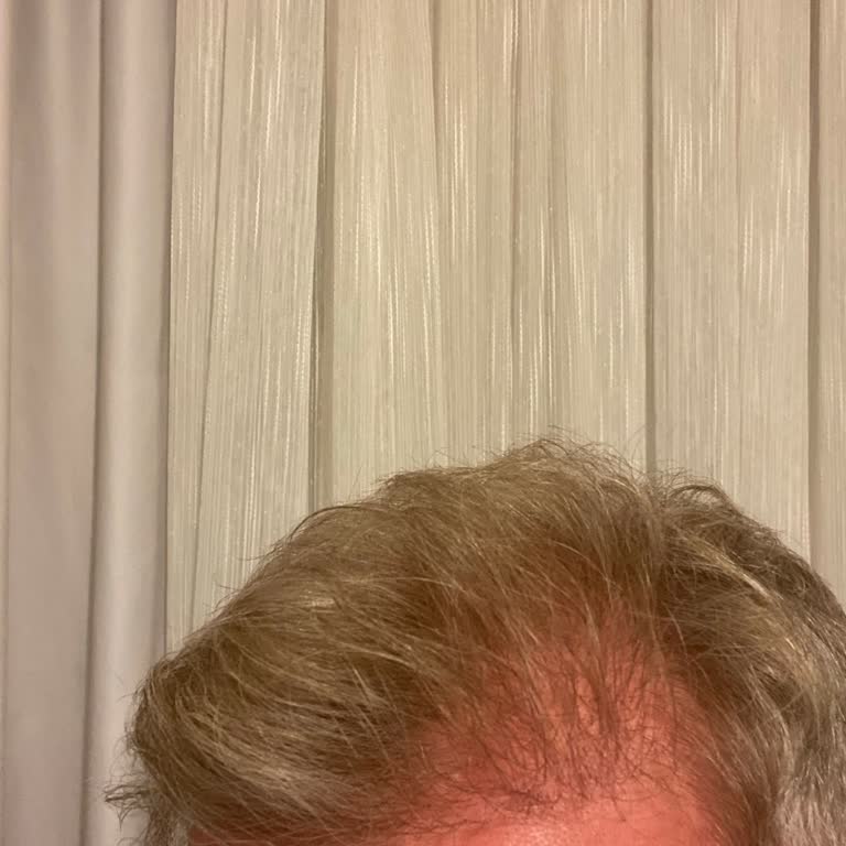 Medical Park Saç Ekimi Sonuçsuz, Fiyatı Aşırı Ve Sadece İkinci Ekim Teklifi