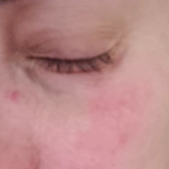 Yves Rocher Göz Kremi Kullanımından Sonra Göz Şişliği Ve Kaşıntı, İade Talebine Yanıt Gelmedi