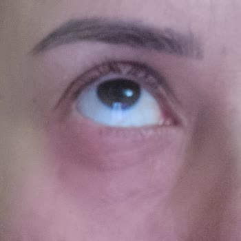 Yves Rocher Göz Kremi Kullanımından Sonra Göz Şişliği Ve Kaşıntı, İade Talebine Yanıt Gelmedi