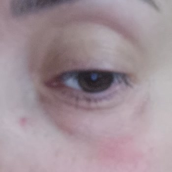 Yves Rocher Göz Kremi Kullanımından Sonra Göz Şişliği Ve Kaşıntı, İade Talebine Yanıt Gelmedi