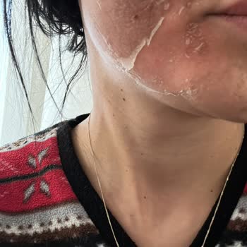 Hugua Estetik & Güzellik Yanık ve Leke Artışı Yaratan Estetik İşlem İçin 7.000 Tl İadesi Talebi