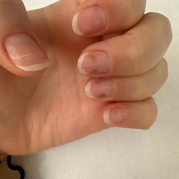 Afrodit Gebze'de Protez Tırnak İşlemi Sonrası Mantar Ve İlgisizliğinden İade Talebi