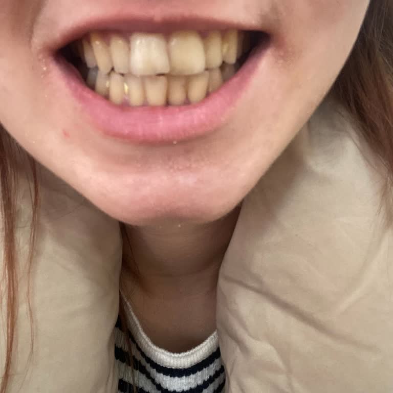 Denteymen Clinic Tedavi Bittikten Sonra Çok Kısa Sürede Dişlerimde Bozulma Yaşadım!