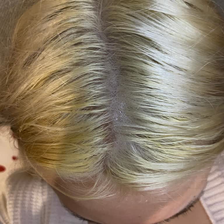 Palette Saç Boyasından Kimyasal Yanık Ve Tedavi Masrafları Talebi