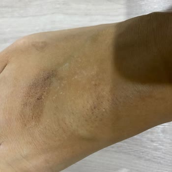 Lazer Paketi Sonrası Ağır Yanık Ve İade İsteğine Cevap Yok