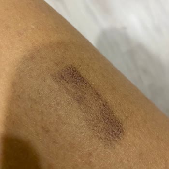 Lazer Paketi Sonrası Ağır Yanık Ve İade İsteğine Cevap Yok