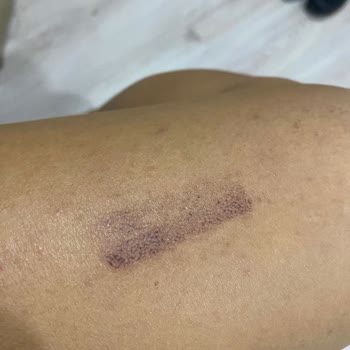 Lazer Paketi Sonrası Ağır Yanık Ve İade İsteğine Cevap Yok