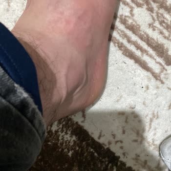 Bursa Yüksek İhtisas Hastanesi Travma Bölümünde İlgisiz Ve Yanıltıcı Tedavi