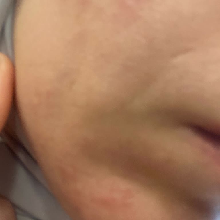 Cildimde Şiddetli Tahriş Ve Alerjik Reaksiyon Nedeniyle Ürün İadesi Talebi