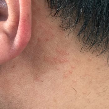 Uraw Mavi Serum Kullanımından Sonra Kızarıklık Ve Yara Gelişmesi, Firmaya Ulaşamama Ve İade Talebi