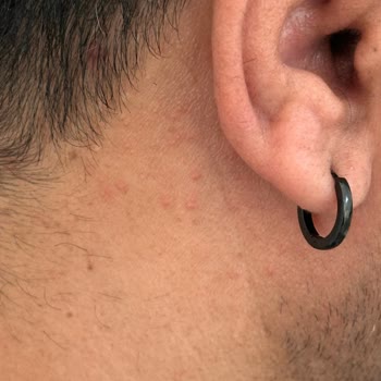 Uraw Mavi Serum Kullanımından Sonra Kızarıklık Ve Yara Gelişmesi, Firmaya Ulaşamama Ve İade Talebi