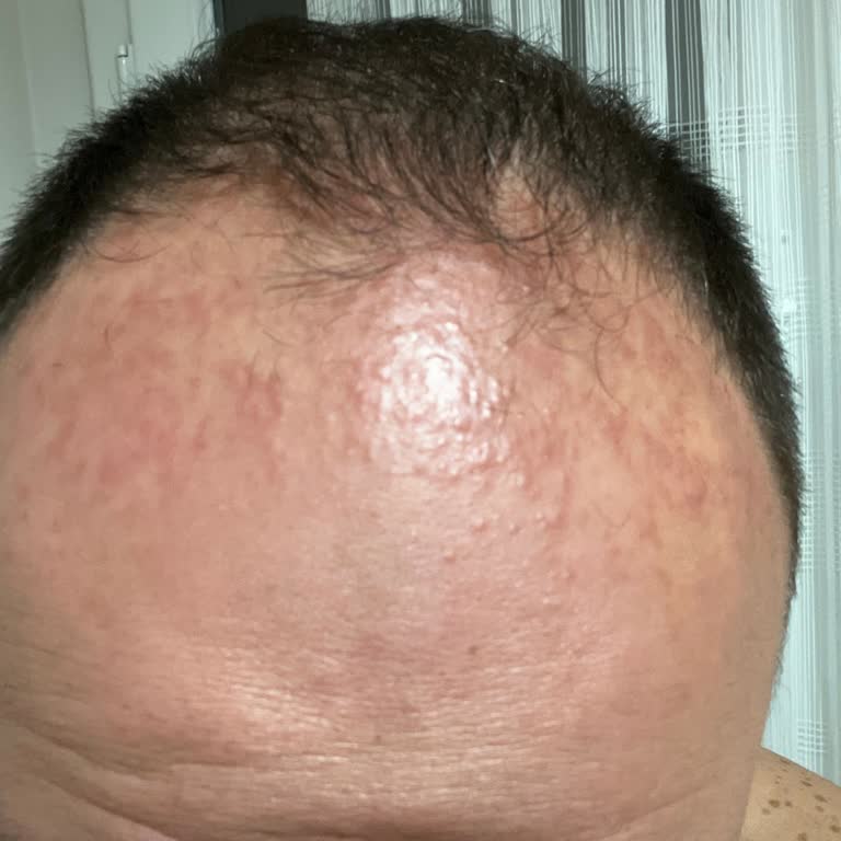 Uraw Mavi Serum Kullanımından Sonra Kızarıklık Ve Yara Gelişmesi, Firmaya Ulaşamama Ve İade Talebi