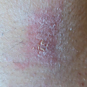 Lazer Epilasyon Sonrası Yanıklar Ve Yetkili İletişim Eksikliği