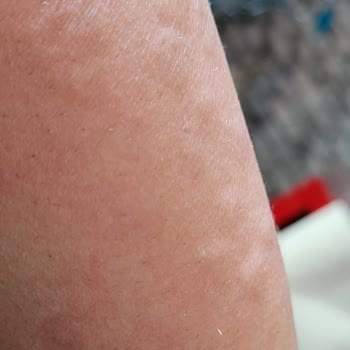 Lazer Epilasyon Sonrası Yanıklar Ve Yetkili İletişim Eksikliği