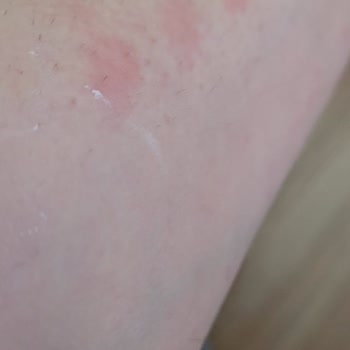 Lazer Epilasyon Sonrası Yanıklar Ve Yetkili İletişim Eksikliği