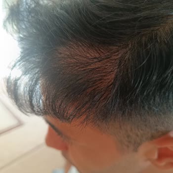 Gaziantepsacekim.com Ekilen Saç Tutmadı!