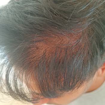 Gaziantepsacekim.com Ekilen Saç Tutmadı!