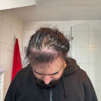 Rönesans Peruka Orijinal Özbek Saçı İddiası Yanıltıcı, Keratin Kalitesi Saçlarımı Kırdı