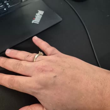 Neutrogena Yoğun Nemlendirici Kremi Ciltte Soyulma Ve Kir Birikimi Yarattı