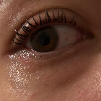 Göz Altı Bandı Olmadan Kirpik Lifting Sonrası Tahriş Ve İade Talebi