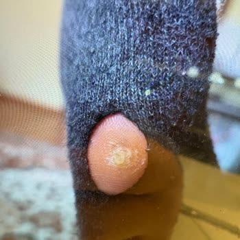 Ayak Ağrısına Neden Olan Salomon Ayakkabısı İçin İade Talebi