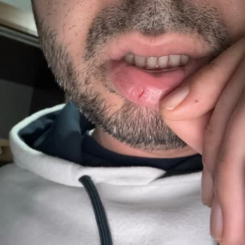 İçecek İçinde Bulunan Yabancı Cisim Dudak Kesilmesine Neden Oldu