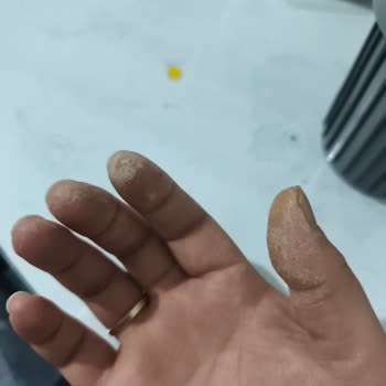 Vanish Kosla Sıvı Deterjanı El Yanmasına Ve Ciddi Sağlık Sorununa Yol Açtı