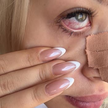 İpek Kirpik İşlemi Sonrası Göz Kızarıklığı Ve Cevapsız Salon İade Talebi