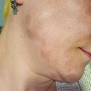 Aşırı Lazer Dozu Yanığa Ve Kalıcı Lekelere Neden Oldu İade Talebi