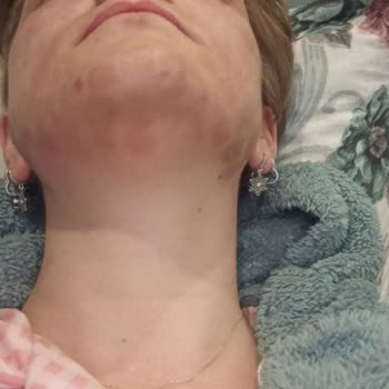 Aşırı Lazer Dozu Yanığa Ve Kalıcı Lekelere Neden Oldu İade Talebi