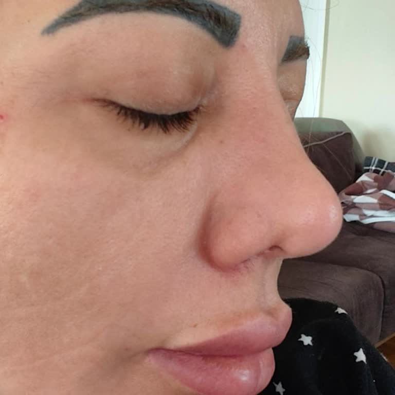 Büyük Anadolu Hastanesi Darıca İki Defa Burun Ameliyatı Sonrası Çökme Ve Hastane Sorumluluğu!