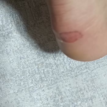 Botun Şiddetli Çarpmasıyla Oluşan Ayak Yaraları Ve İade Talebi