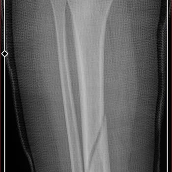 Vega Ice Buz Pisti'nde Kontrolsüz Kalabalık Çocuğumun Bacağını Kırdı Ve Sorumluluk Reddedildi