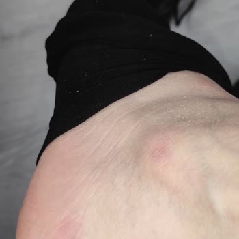 Ayıplı Outdoor Botta Taban Kayması Nedeniyle Bilek Ağrısı Ve İade Reddi