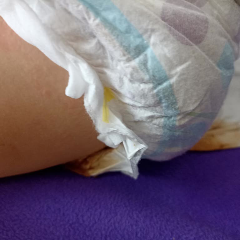 Molfix Bebek Bezinde Sürekli Sızdırma Ve Külot Bezinin Aşırı Sıkması