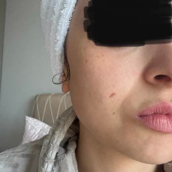 Yanlış HIFU Uygulaması Sonrası Kalıcı İz Ve Ücret İadesi Talebi