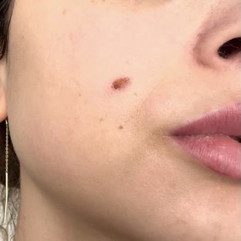 Yanlış HIFU Uygulaması Sonrası Kalıcı İz Ve Ücret İadesi Talebi