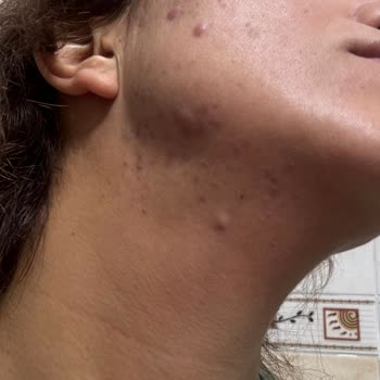 İşlem Sonrası Kalıcı İz Ve Fatura Kesilmemesi Nedeniyle İade İsteği