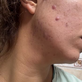 İşlem Sonrası Kalıcı İz Ve Fatura Kesilmemesi Nedeniyle İade İsteği