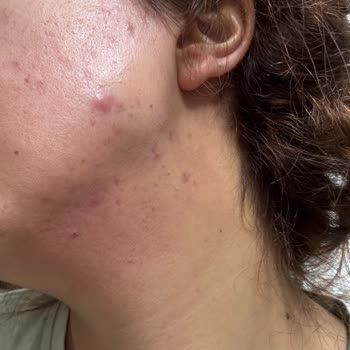 İşlem Sonrası Kalıcı İz Ve Fatura Kesilmemesi Nedeniyle İade İsteği