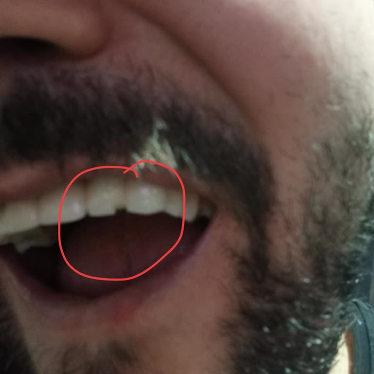 Ülker Çubuk Krakerinde Sert Yabancı Madde Diş Kırılmasına Sebep Oldu