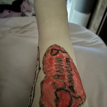 IKEA Kapalı Otoparkta Güvenlik Önlemi Olmadan Ayak Bileği Kırılması Ve Ciddi Mağduriyet