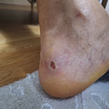 Sağlık Sorununa Neden Olan Bot İçin İade Ve Mağaza Çalışanlarının Kaba Tutumu