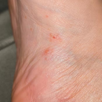 Watsons Clasy Care Kremi Sonrası Şiddetli Kaşıntı Ve Yaralar Nedeniyle Ücret İadesi Talebi