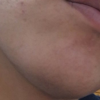 Korendy Anua Azelaic 10 Hyaluron Serumu Cildimde Şiddetli Hassasiyet Yarattı Ve İade Talep Ediyorum