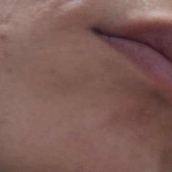 Korendy Anua Azelaic 10 Hyaluron Serumu Cildimde Şiddetli Hassasiyet Yarattı Ve İade Talep Ediyorum